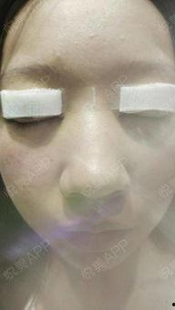 手术前照片,手术前后的视觉对比解析